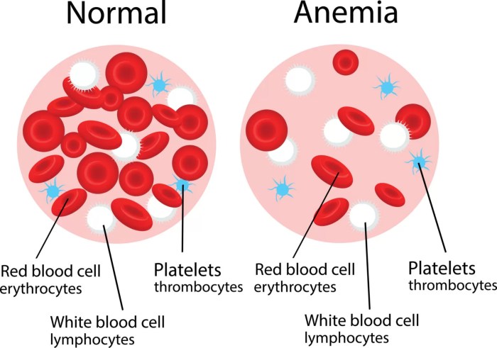 Pengertian anemia menurut who