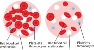 Pengertian anemia menurut who